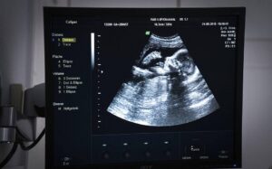 Gay couple seek partial refund if surrogate has a girl